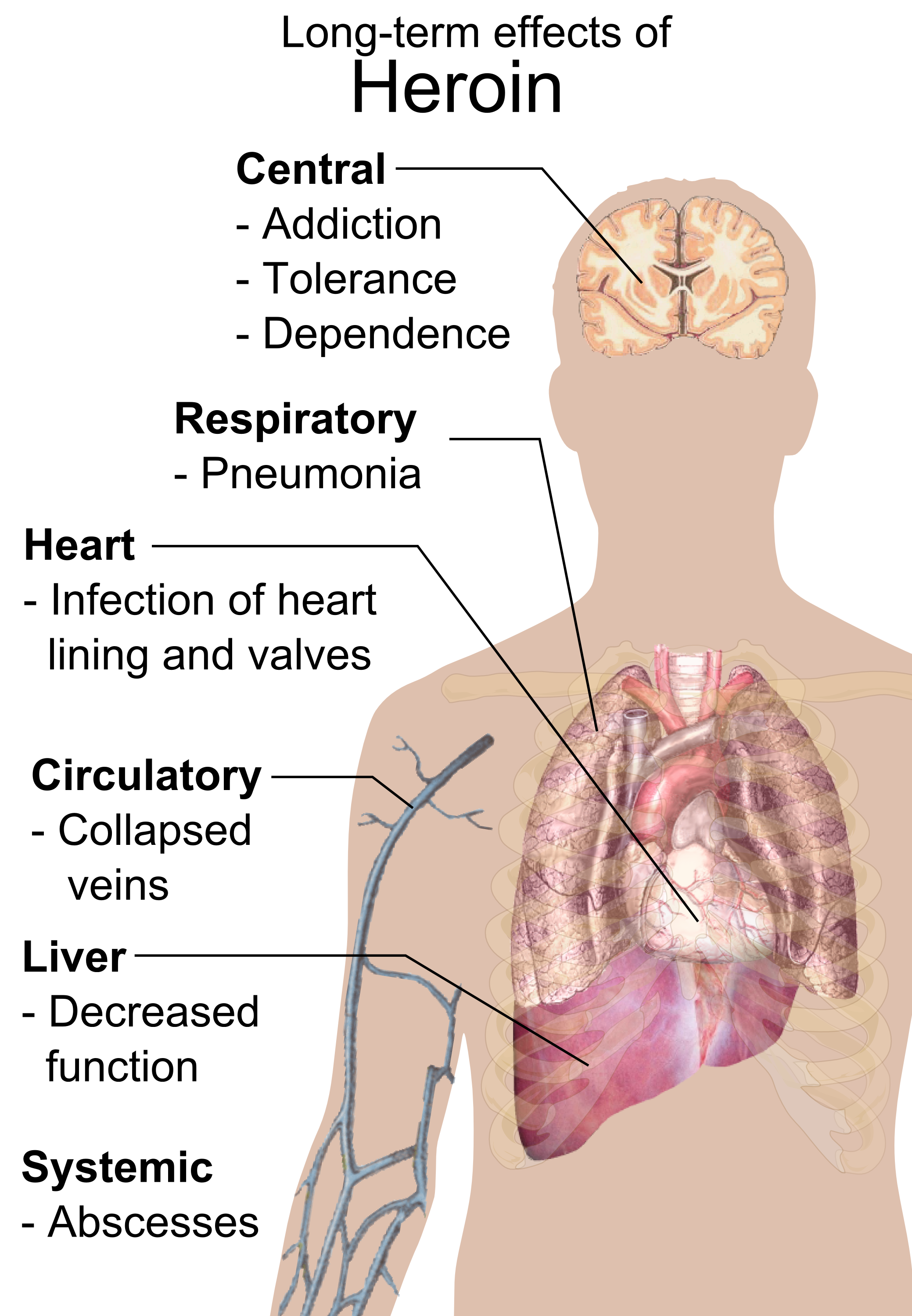 1_effects_of_heroin.png